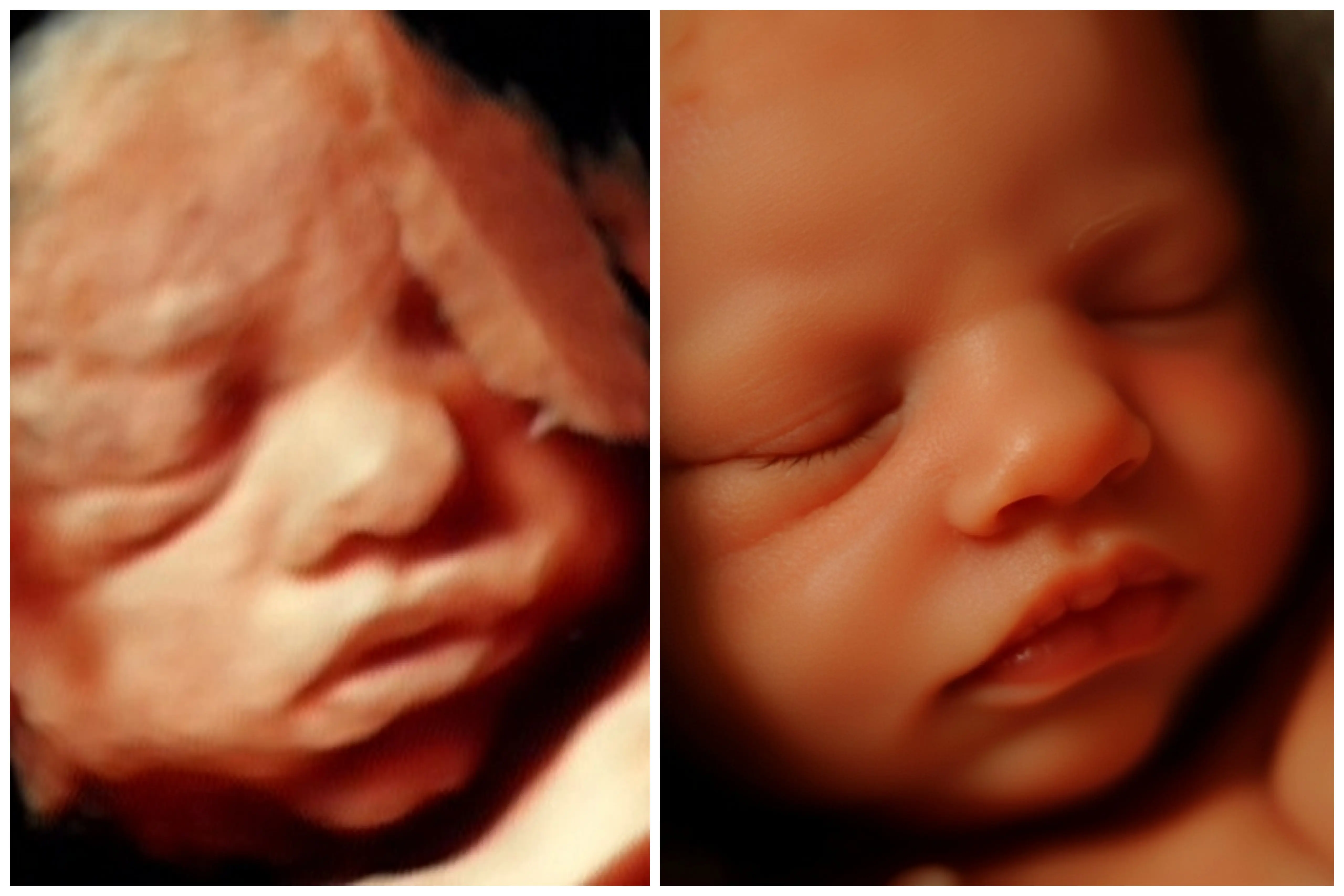 Ecografía 8K HD procesada con IA - Econatal Galicia Baleares