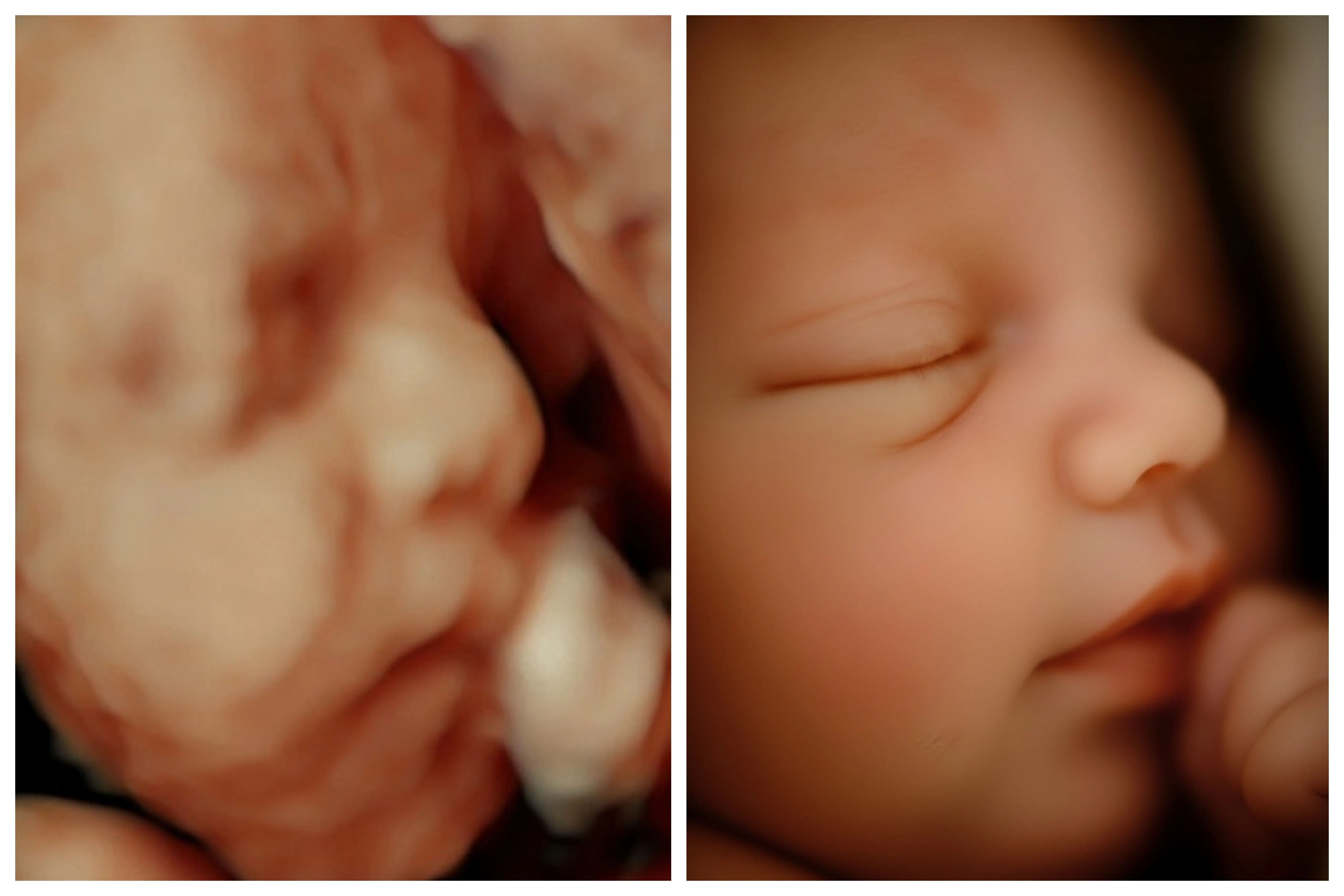 Ecografía 8K HD procesada con IA - Econatal Galicia Baleares