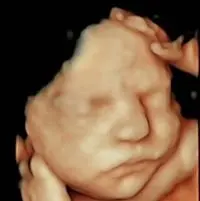 Resultado ecografía 5D en Baleares - Econatal Palma