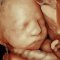 Ecografía 5D emocional resultado real - Econatal A Coruña