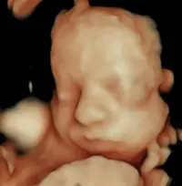 Ecografía 5D emocional resultado real - Econatal Vigo