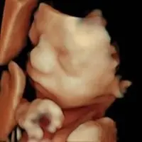 Perfil bebé en ecografía 5D emocional - Econatal Galicia